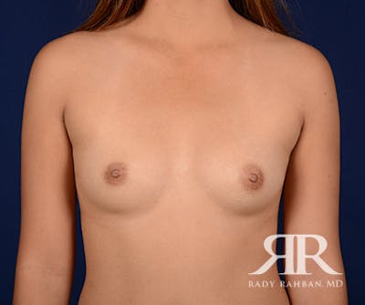 Breast Augmentation Before & After Gallery - Patient 247878 - Image 1