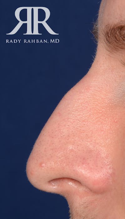Rhinoplasty Close Up Before & After Gallery - Patient 407830 - Image 1