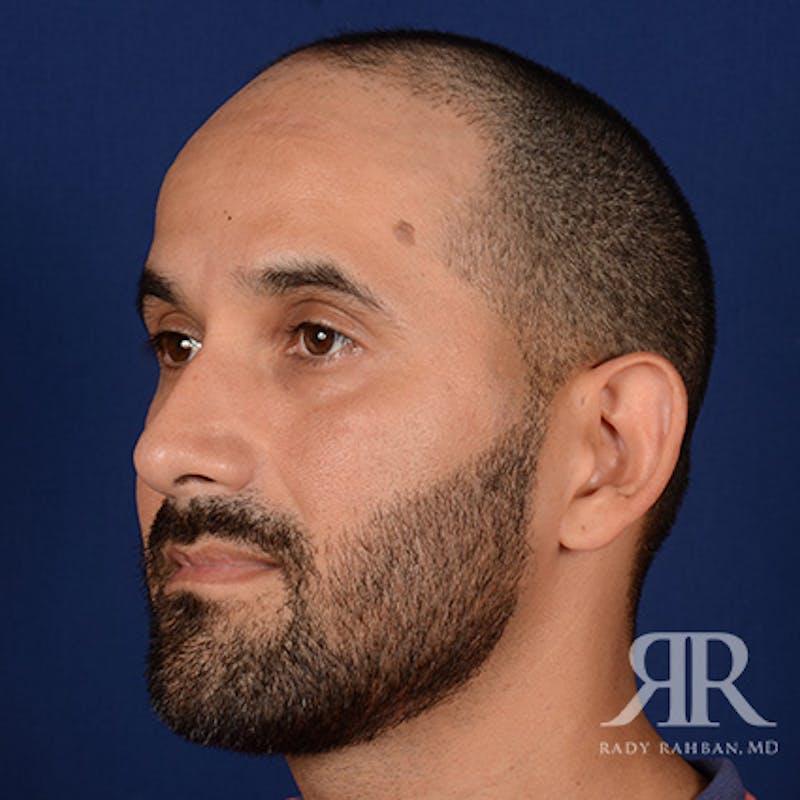 Ear Pinning Surgery Before & After Gallery - Patient 249265 - Image 3