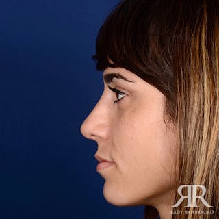 Female Rhinoplasty Before & After Gallery - Patient 122339 - Image 6