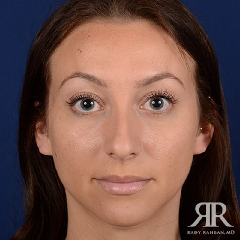 Rhinoplasty w/ Chin Implant Before & After Gallery - Patient 423857 - Image 1