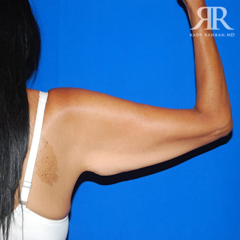 Arm Lift Before & After Gallery - Patient 661592 - Image 5