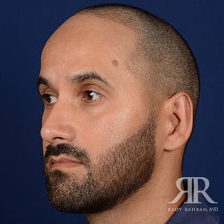 Ear Pinning Surgery Before & After Gallery - Patient 249265 - Image 4