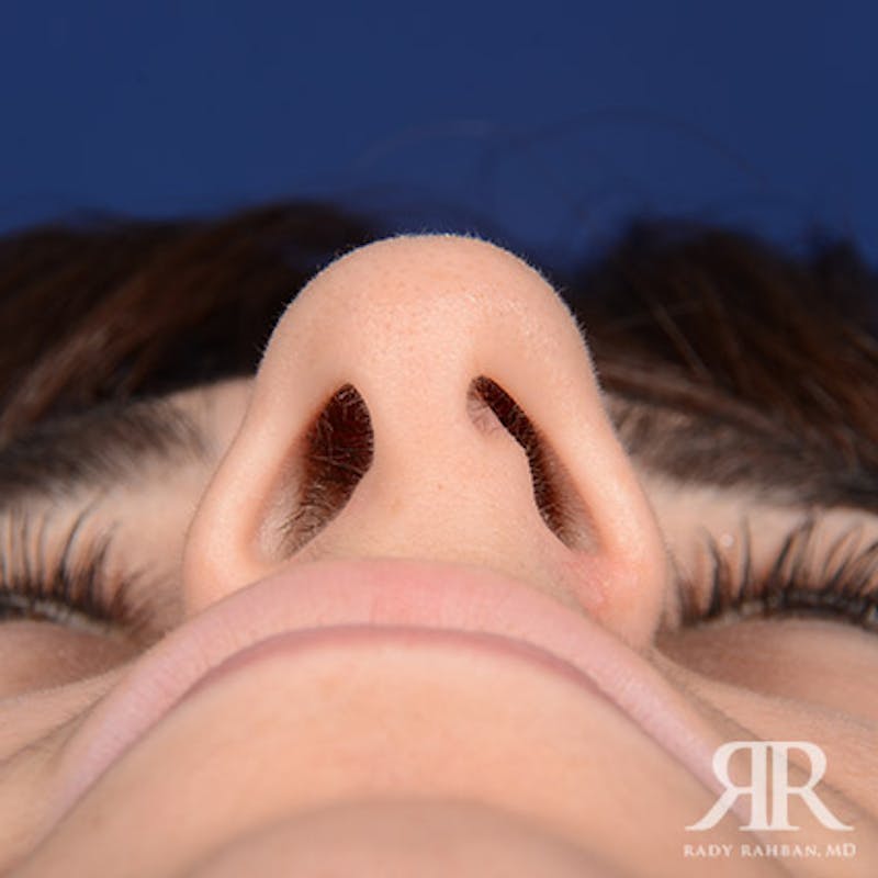 Female Rhinoplasty Before & After Gallery - Patient 122339 - Image 7