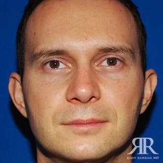 Male Rhinoplasty Before & After Gallery - Patient 350100 - Image 2