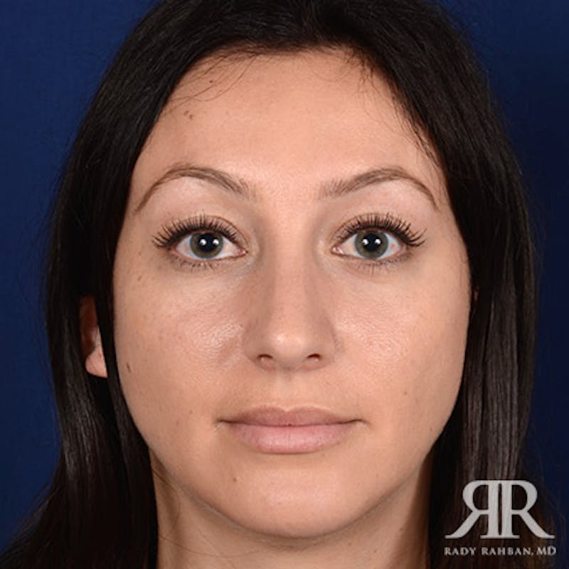 Rhinoplasty w/ Chin Implant Before & After Gallery - Patient 423857 - Image 2