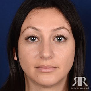 Rhinoplasty w/ Chin Implant Before & After Gallery - Patient 423857 - Image 2