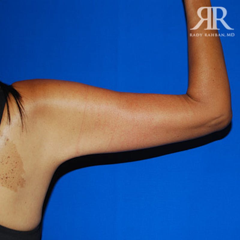 Arm Lift Before & After Gallery - Patient 661592 - Image 6