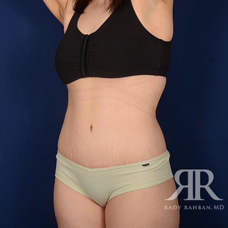 Body Lift Before & After Gallery - Patient 340927 - Image 4