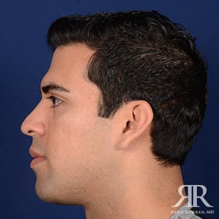 Chin Augmentation Before & After Gallery - Patient 717203 - Image 6