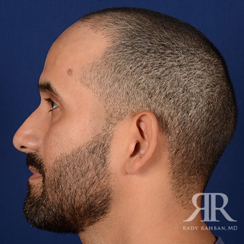 Ear Pinning Surgery Before & After Gallery - Patient 249265 - Image 5
