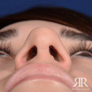 Female Rhinoplasty Before & After Gallery - Patient 122339 - Image 8