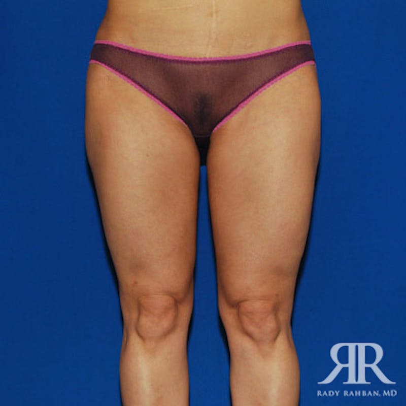 Before and after patient results