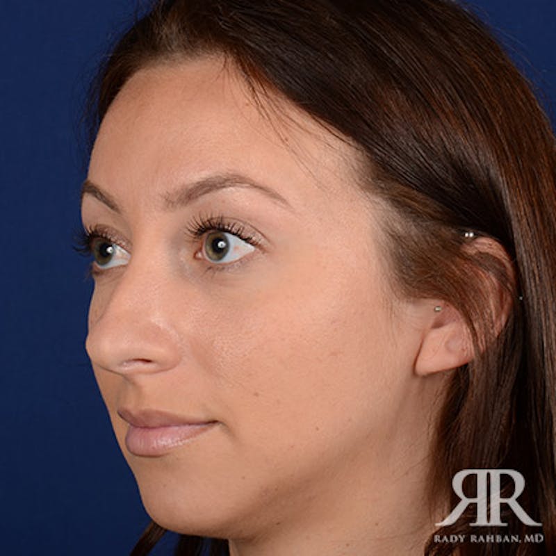Rhinoplasty w/ Chin Implant Before & After Gallery - Patient 423857 - Image 3