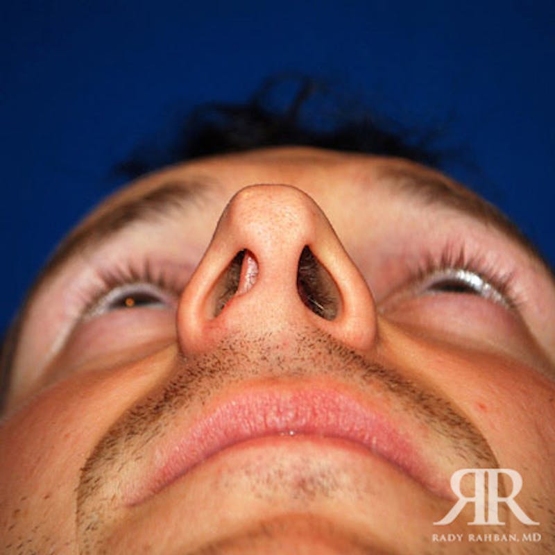 Male Rhinoplasty Before & After Gallery - Patient 350100 - Image 3