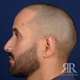 Ear Pinning Surgery Before & After Gallery - Patient 249265 - Image 6