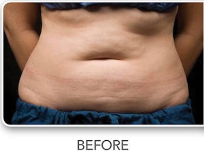 CoolSculpting Before & After Gallery - Patient 103278 - Image 1