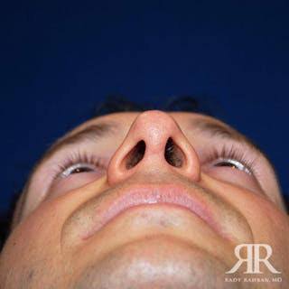 Male Rhinoplasty Before & After Gallery - Patient 350100 - Image 4