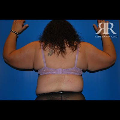 Arm Lift Before & After Gallery - Patient 248448 - Image 1