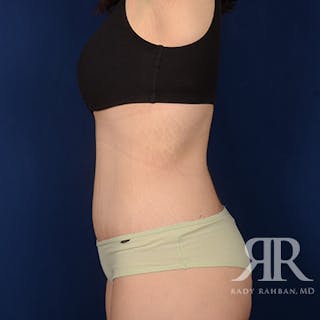 Body Lift Before & After Gallery - Patient 340927 - Image 6