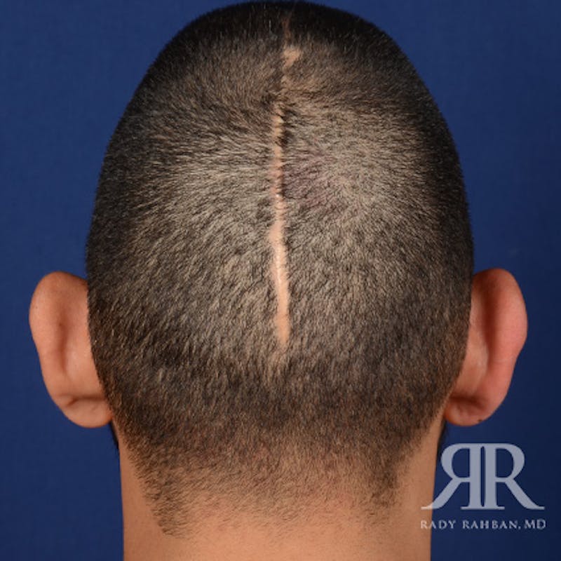 Ear Pinning Surgery Before & After Gallery - Patient 249265 - Image 7