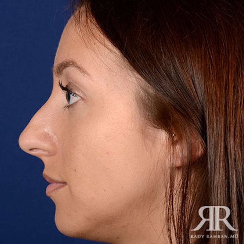 Rhinoplasty w/ Chin Implant Before & After Gallery - Patient 423857 - Image 5