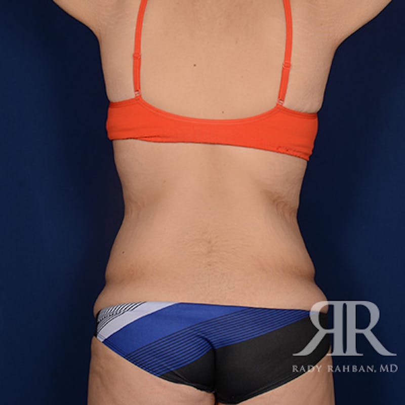 Body Lift Before & After Gallery - Patient 340927 - Image 7