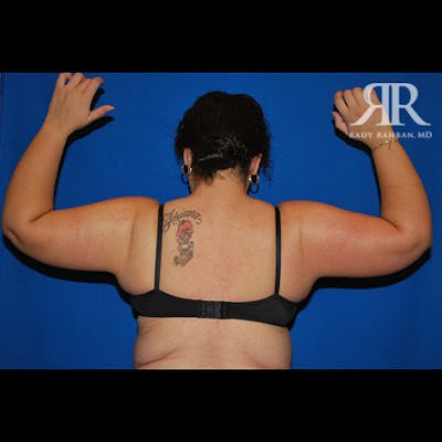 Arm Lift Before & After Gallery - Patient 248448 - Image 2