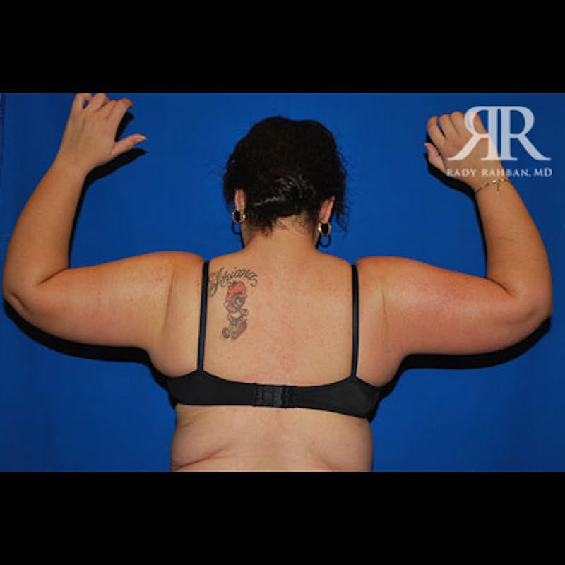 Arm Lift Before & After Gallery - Patient 248448 - Image 2