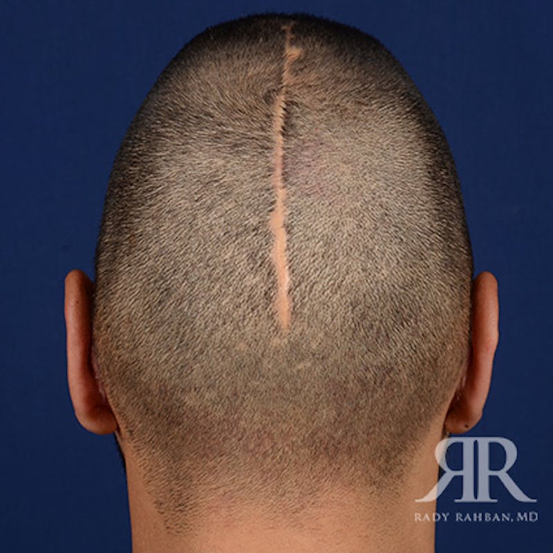Ear Pinning Surgery Before & After Gallery - Patient 249265 - Image 8
