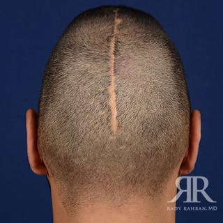 Ear Pinning Surgery Before & After Gallery - Patient 249265 - Image 8