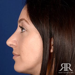 Rhinoplasty w/ Chin Implant Before & After Gallery - Patient 423857 - Image 6