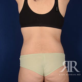 Body Lift Before & After Gallery - Patient 340927 - Image 8