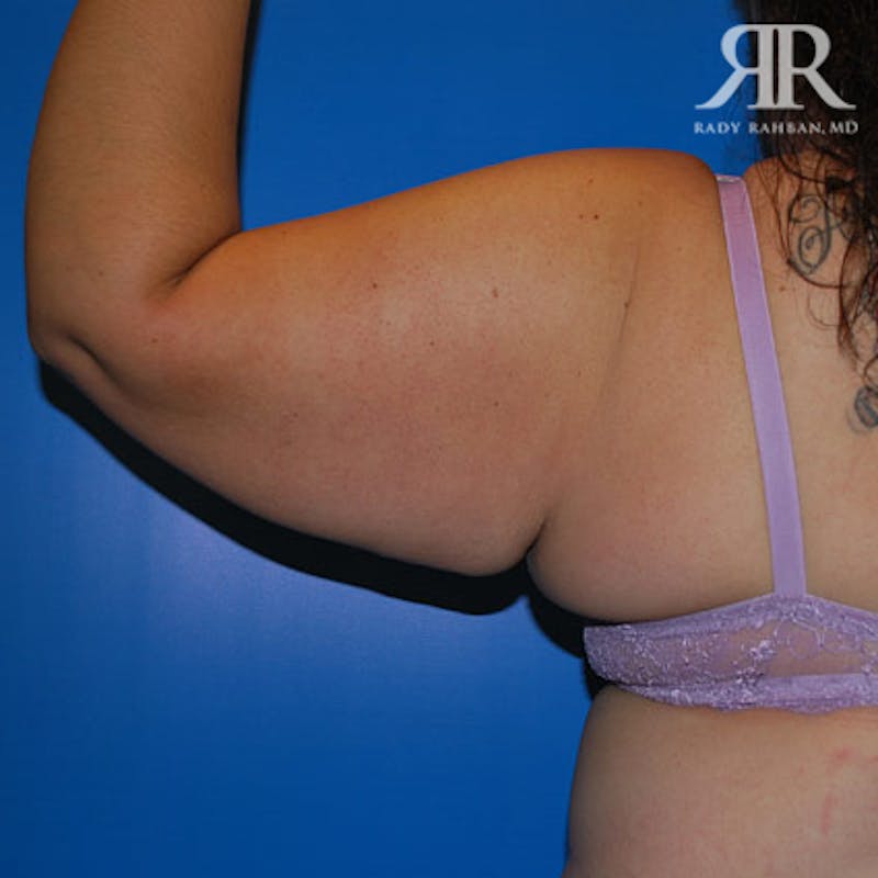 Arm Lift Before & After Gallery - Patient 248448 - Image 3