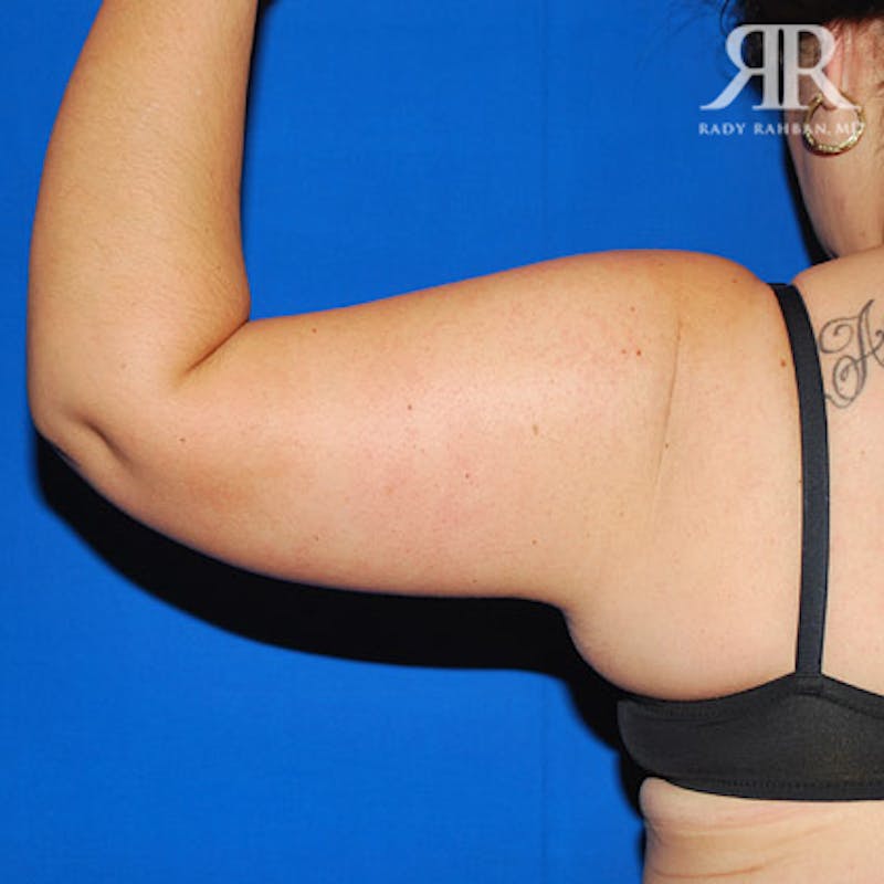 Arm Lift Before & After Gallery - Patient 248448 - Image 4
