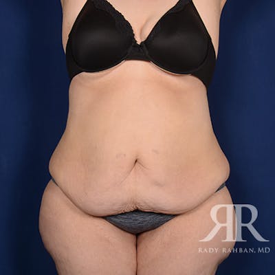Body Lift Before & After Gallery - Patient 295631 - Image 1