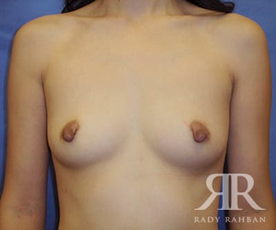 Breast Augmentation Before & After Gallery - Patient 207735 - Image 1