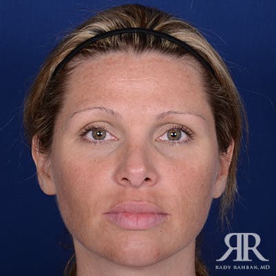 Corrective / Revision Rhinoplasty Before & After Gallery - Patient 367292 - Image 1