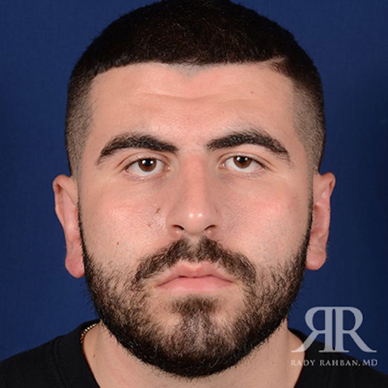 Ear Pinning Surgery Before & After Gallery - Patient 860857 - Image 2