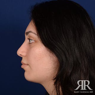 Female Rhinoplasty Before & After Gallery - Patient 280392 - Image 6
