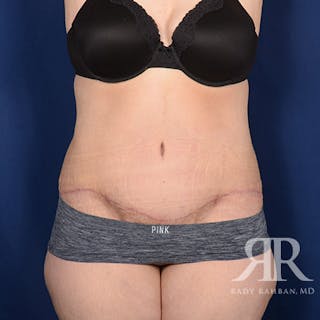 Body Lift Before & After Gallery - Patient 295631 - Image 2
