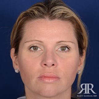 Corrective / Revision Rhinoplasty Before & After Gallery - Patient 367292 - Image 2