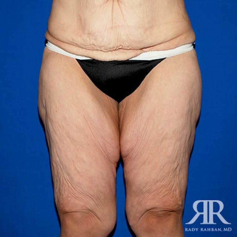 Thigh Lift Before & After Gallery - Patient 427696 - Image 1