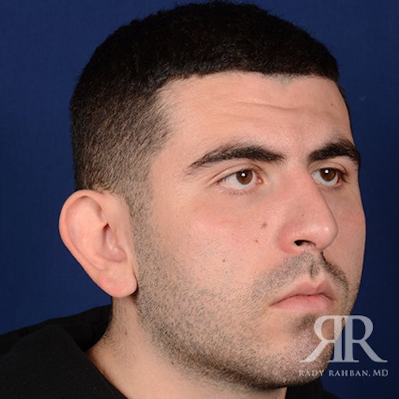 Ear Pinning Surgery Before & After Gallery - Patient 860857 - Image 3