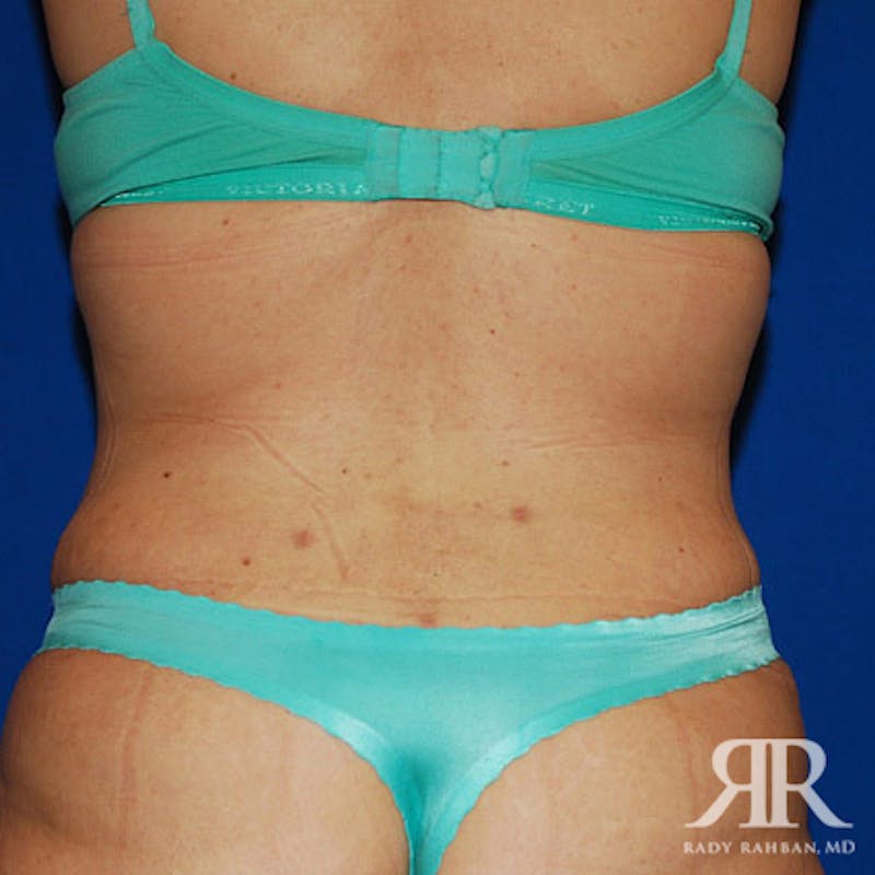 Before and after patient results