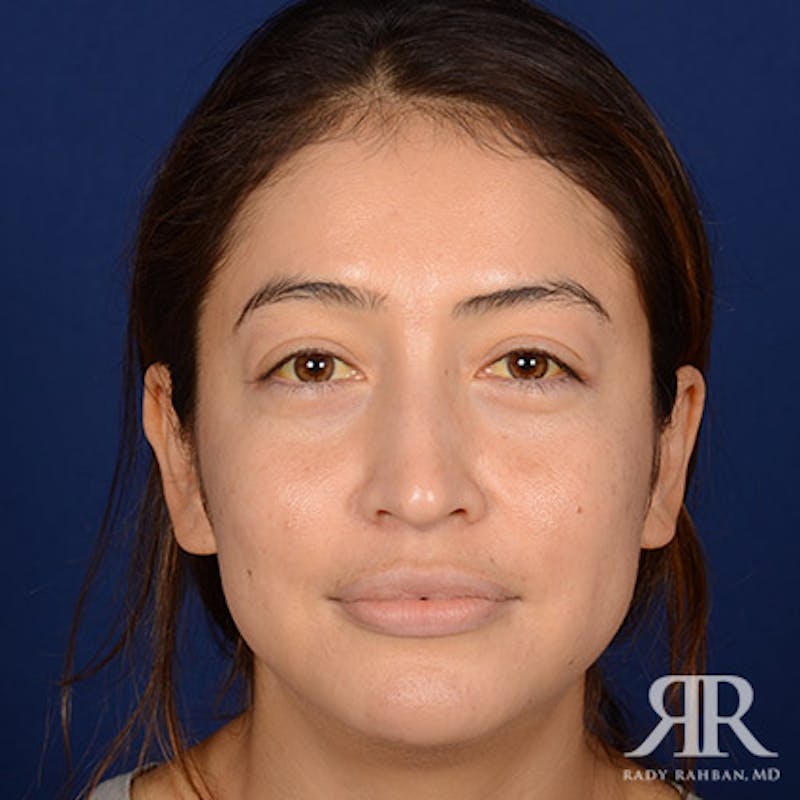 Female Rhinoplasty Before & After Gallery - Patient 176852 - Image 1