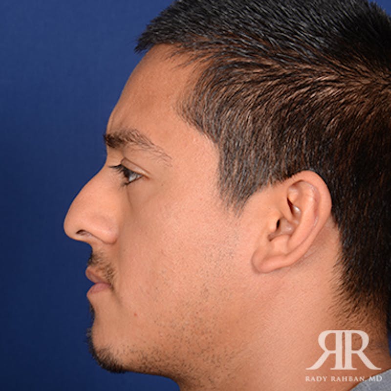 Ethnic Rhinoplasty Before & After Gallery - Patient 207111 - Image 5
