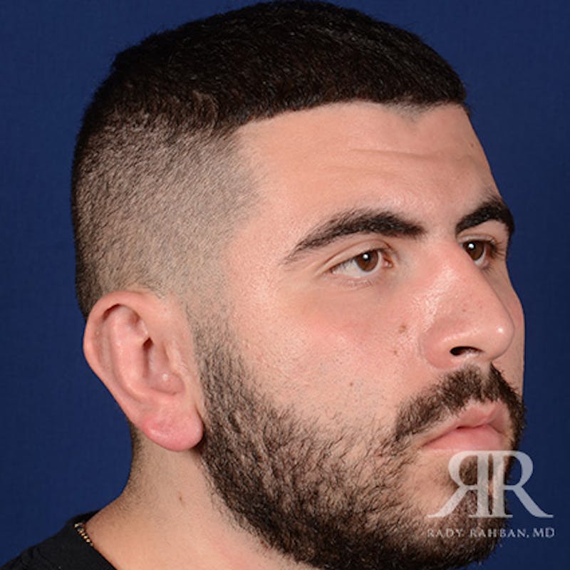 Ear Pinning Surgery Before & After Gallery - Patient 860857 - Image 4