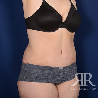 Body Lift Before & After Gallery - Patient 295631 - Image 4