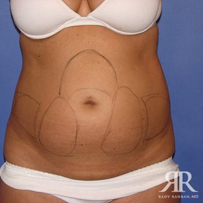 Liposuction Before & After Gallery - Patient 169261 - Image 1